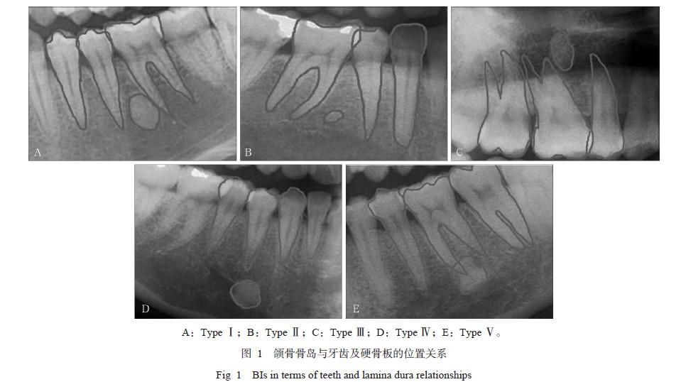 根据颌骨骨岛与牙齿及硬骨板的位置关系,将骨岛分为 5类[3],具体如下