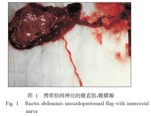 下腹直肌瓣制取:于左侧下腹部(脐下)腹中线外侧做10 cm的纵行切口.