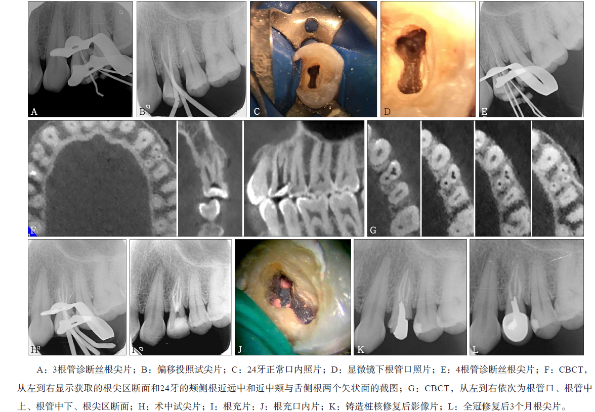 牙内根管治疗过程图片下载 - 觅知网