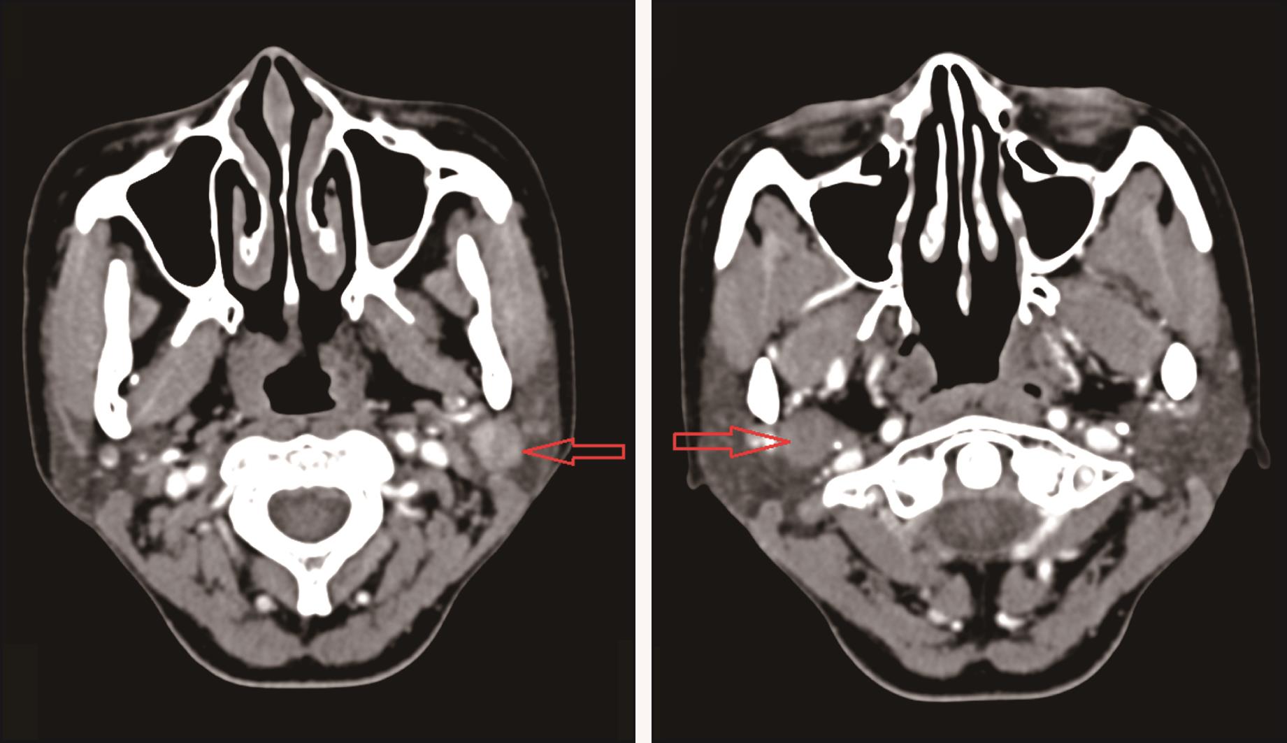 双侧腮腺同时发生不同病理类型的良性肿瘤 1 例
