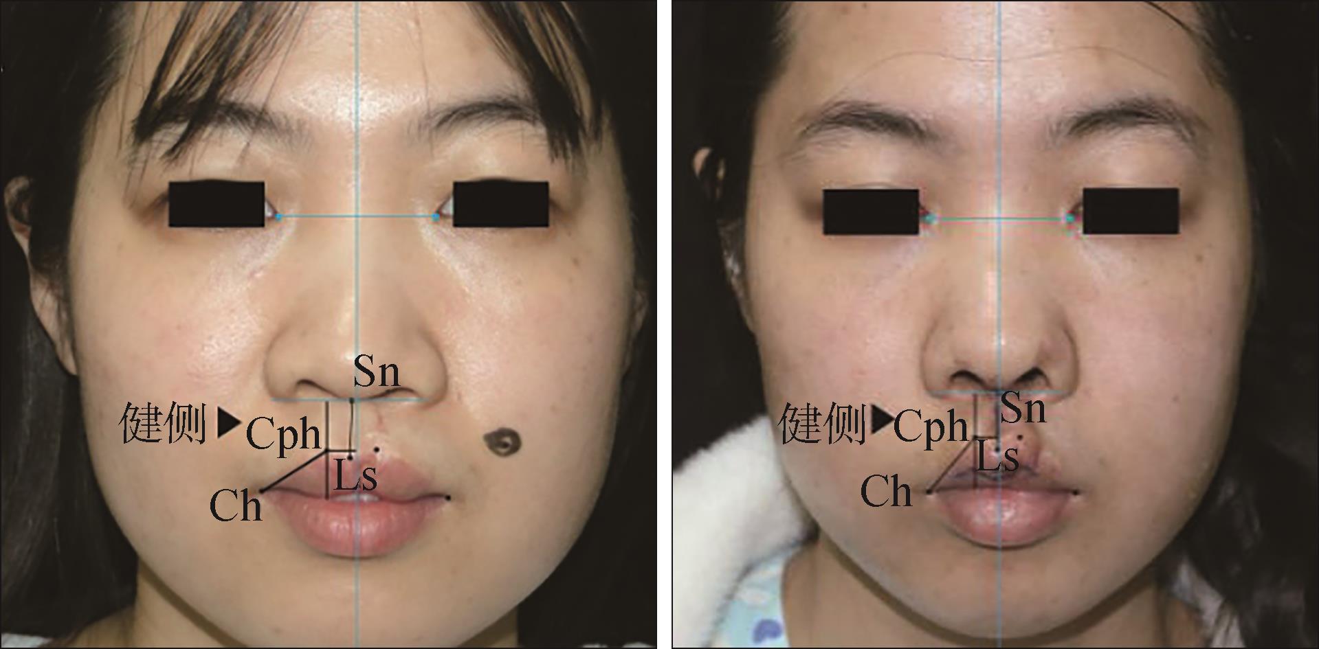 唇裂I期后遗留的各种畸形及唇裂II期疤痕畸形的修复 - 知乎