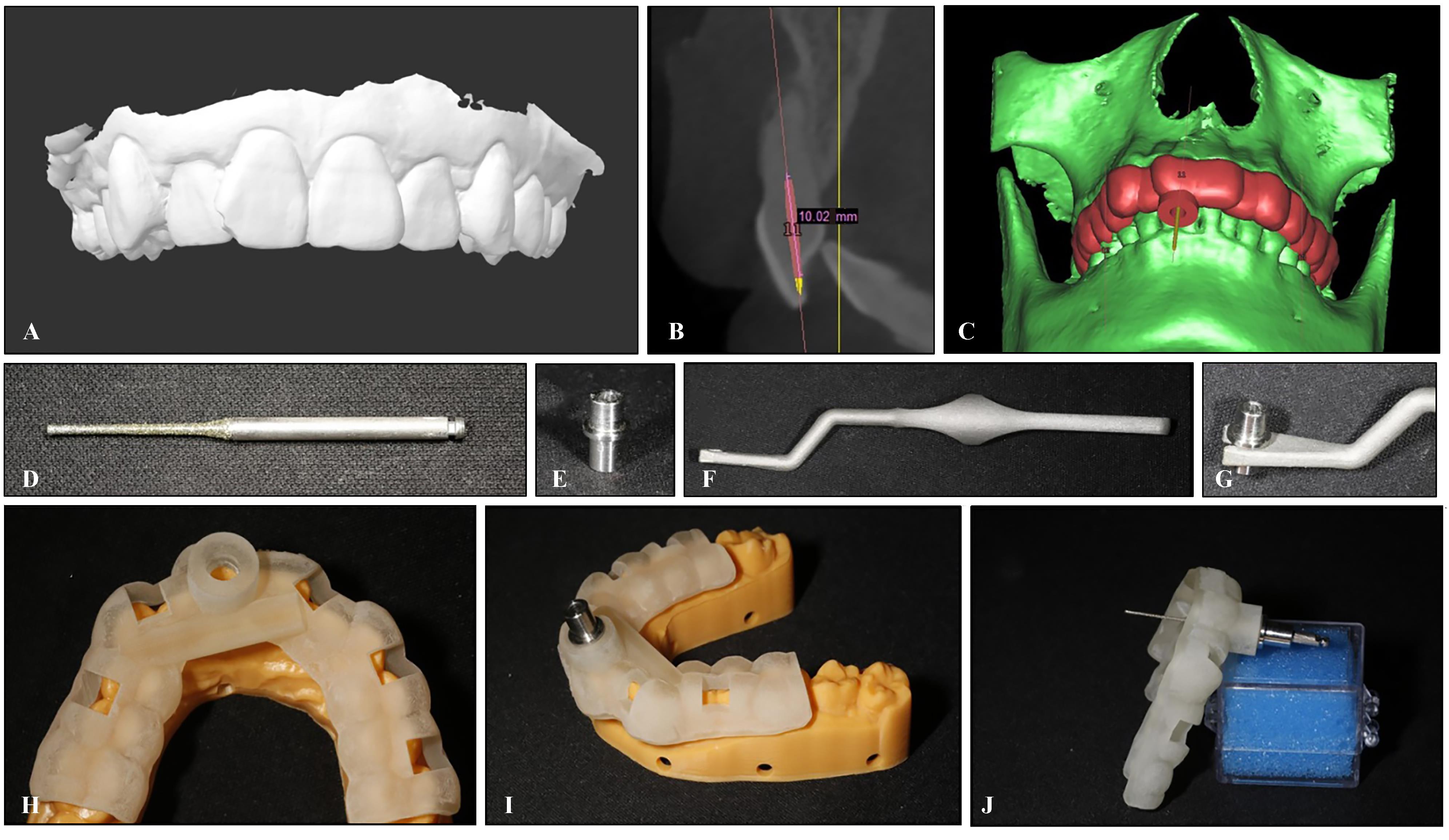 定制式牙科种植导板案例