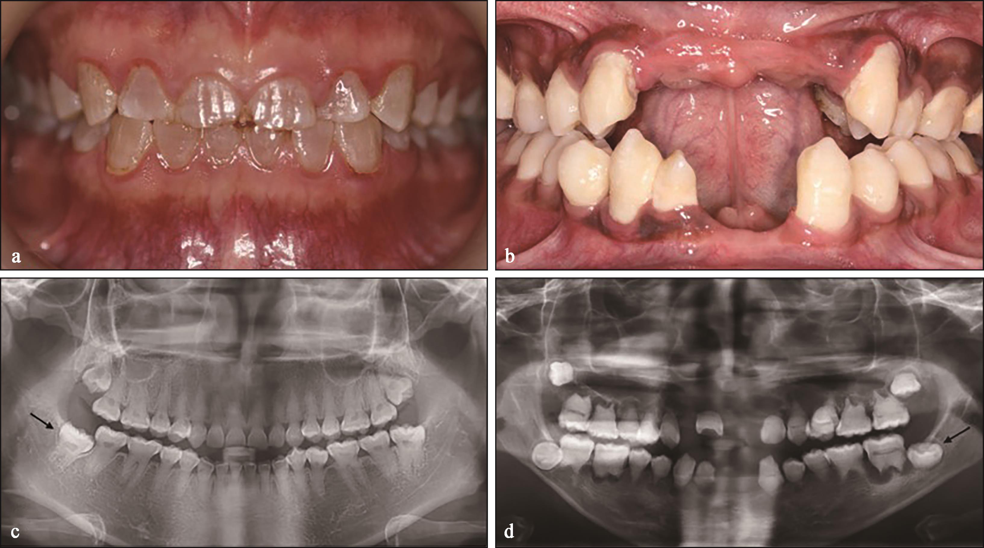 门牙缝大+先天性前牙缺失矫正案例