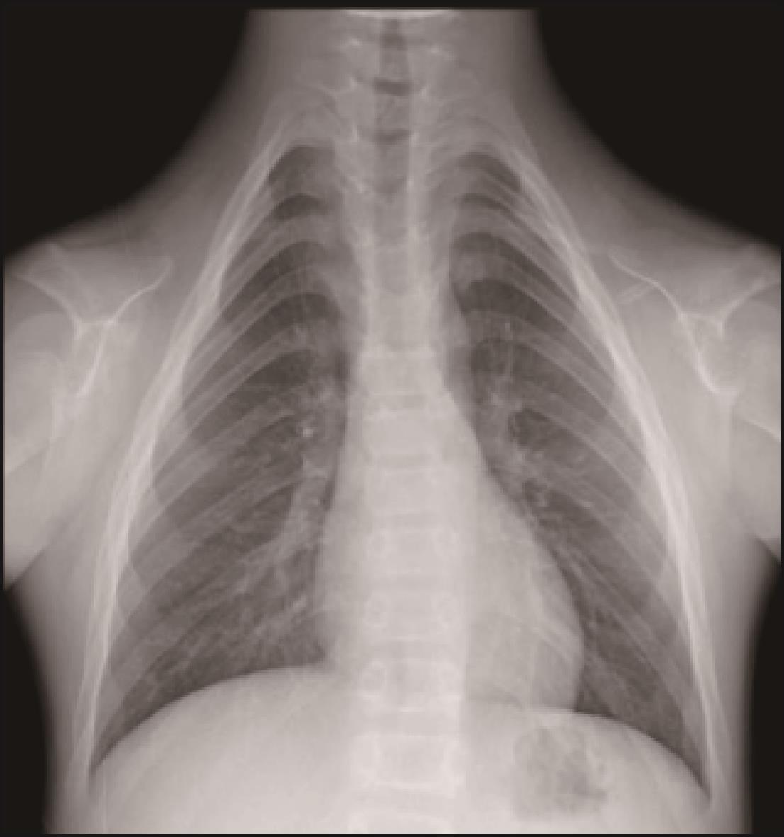 椎体软骨发育不良伴免疫调节异常影像表现1例 - 中华放射学杂志