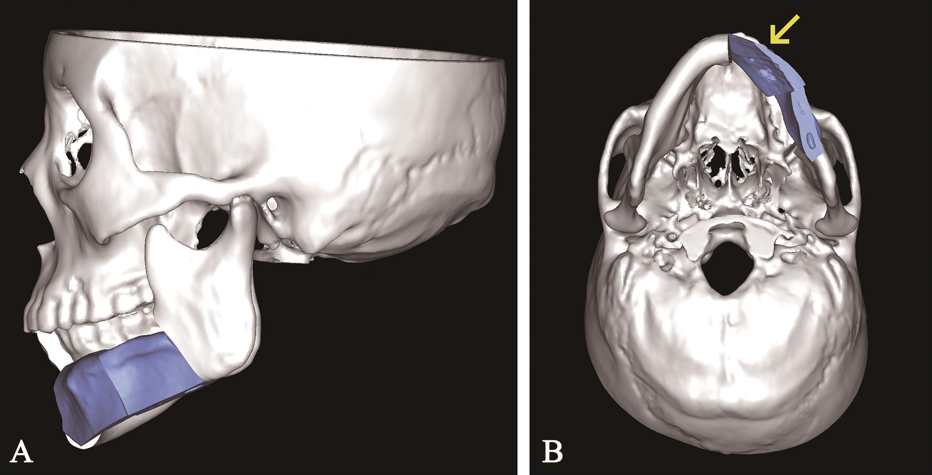 下颌骨髁突骨折的诊治方案：基于上海交通大学医学院附属第九人民医院颞下颌关节中心的经验