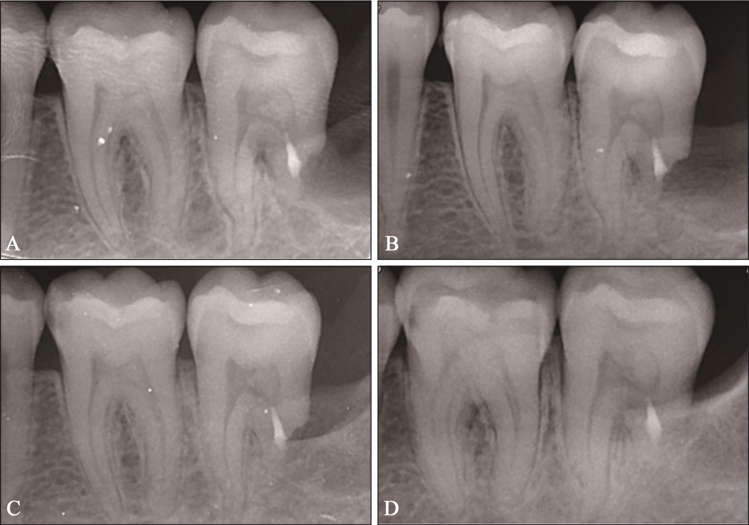 乳牙牙根吸收 - 知乎