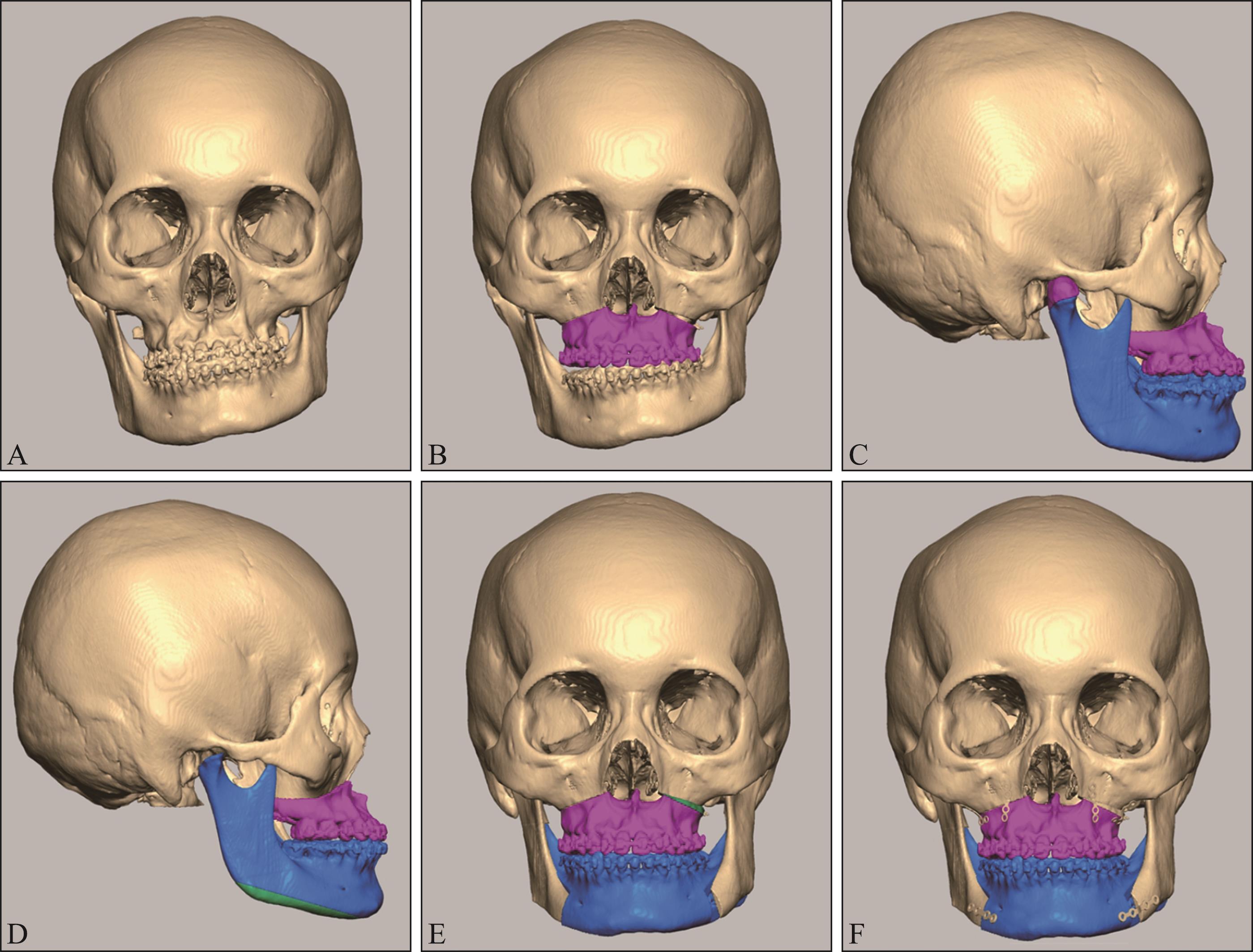 内置式颌骨牵引成骨在疑难牙颌面畸形矫治中的应用-附88例报告_医学论文_医学研究_赛德阳光口腔官方网站