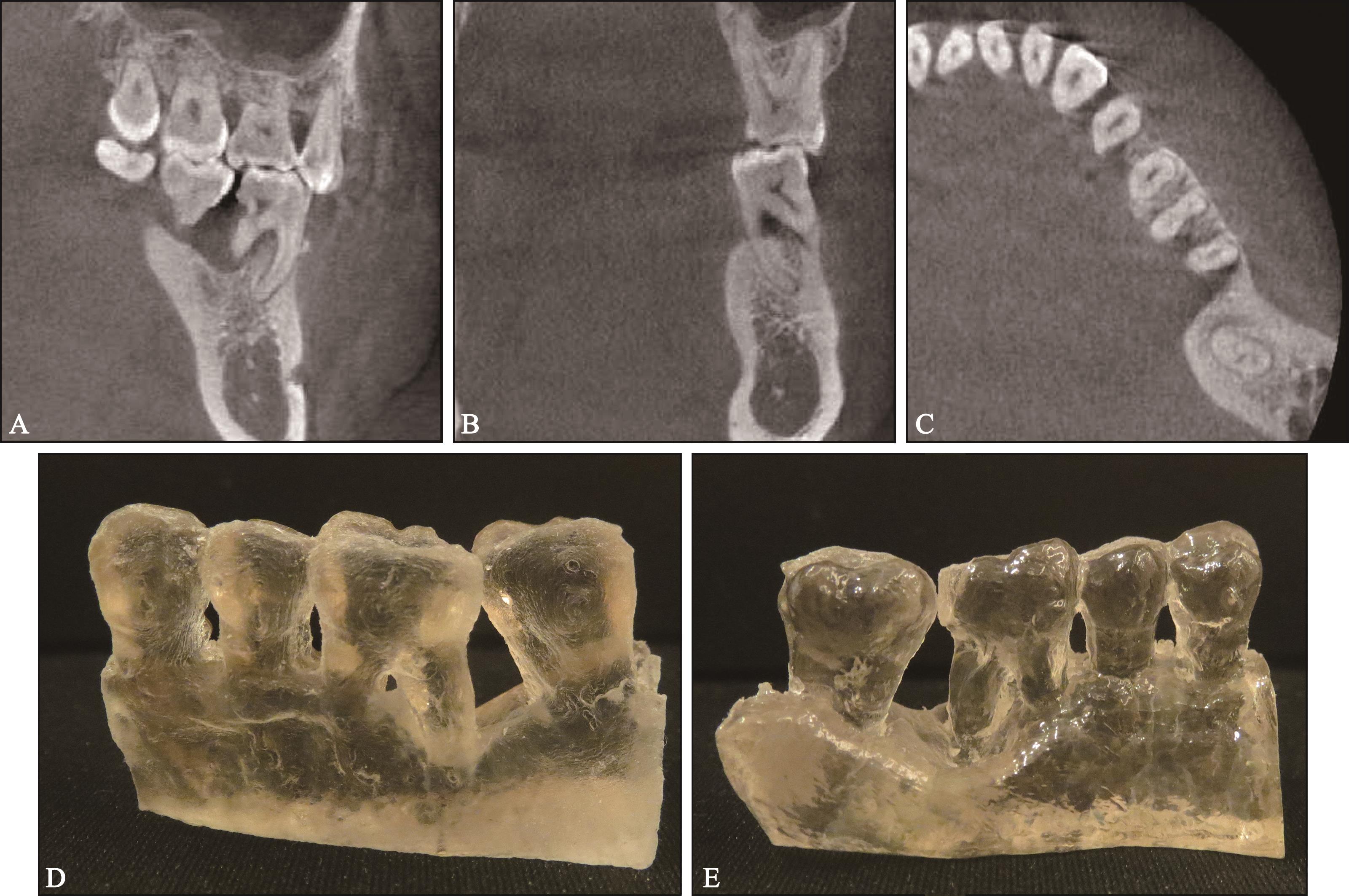 数字化技术联合富血小板纤维蛋白新型牙周再生技术治疗后牙舌侧根分叉病变 6 年随访 1 例