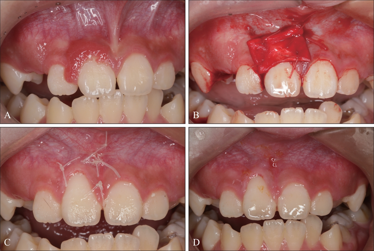 Localized juvenile spongiotic gingival hyperplasia a case report